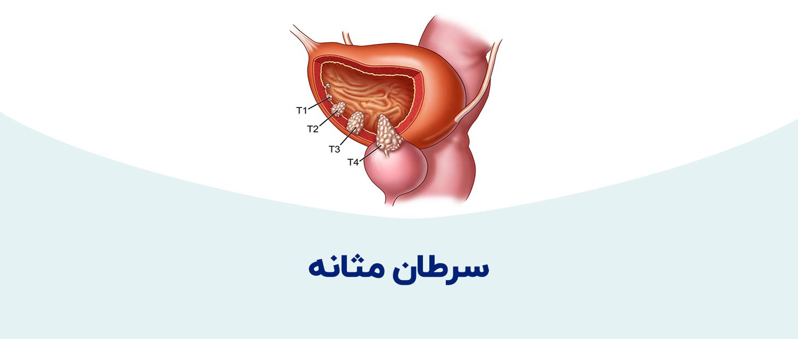 انواع مختلف سرطان که می توان در مثانه تشخیص داد، چیست؟